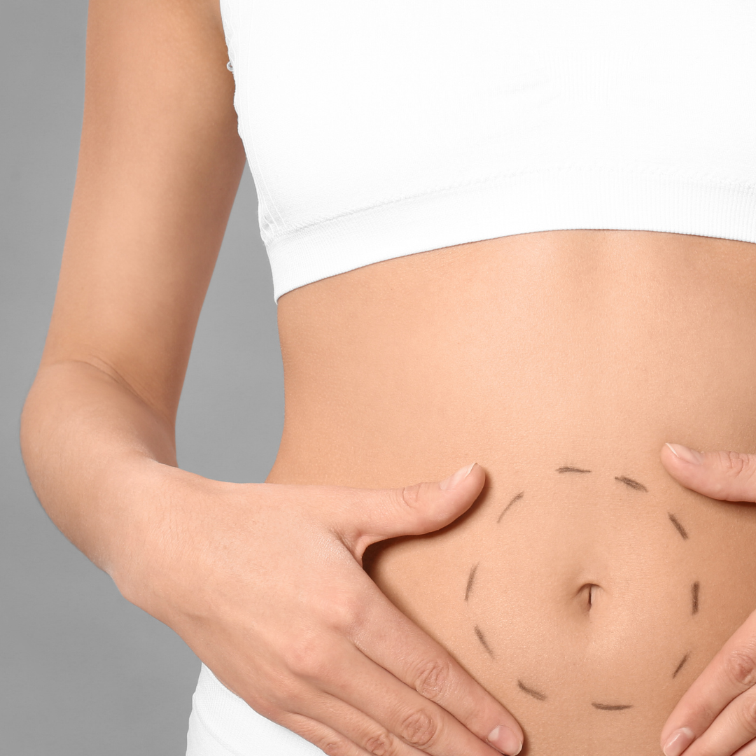 Belly Button Surgery - Medisculpt