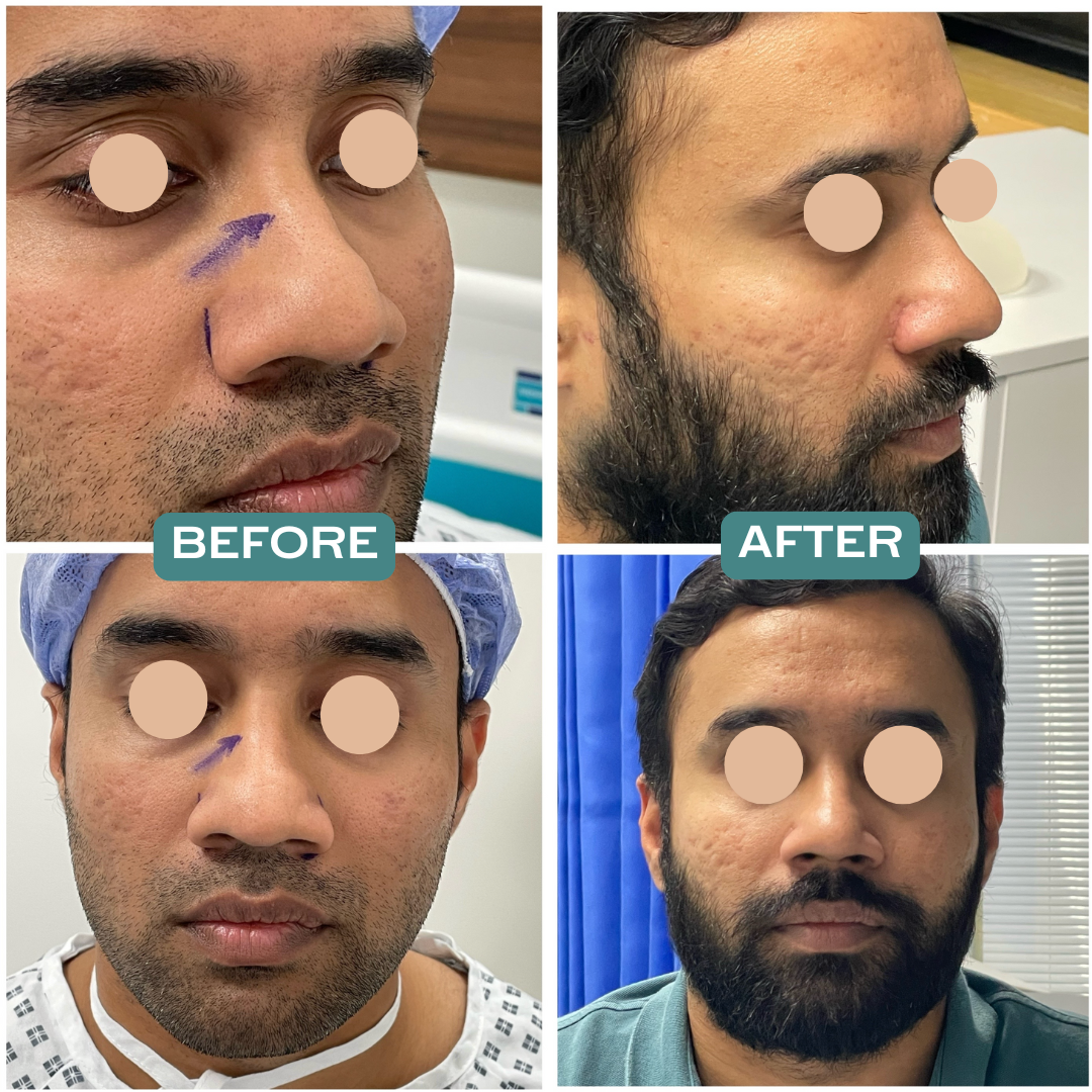 Open Rhinoplasty with Alar Base Reduction