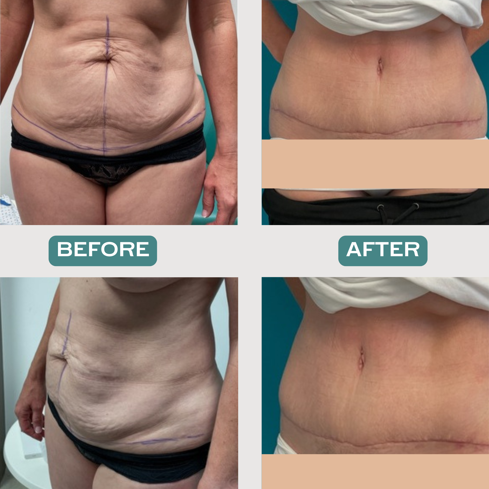 Full Abdominoplasty with Plication of Muscles