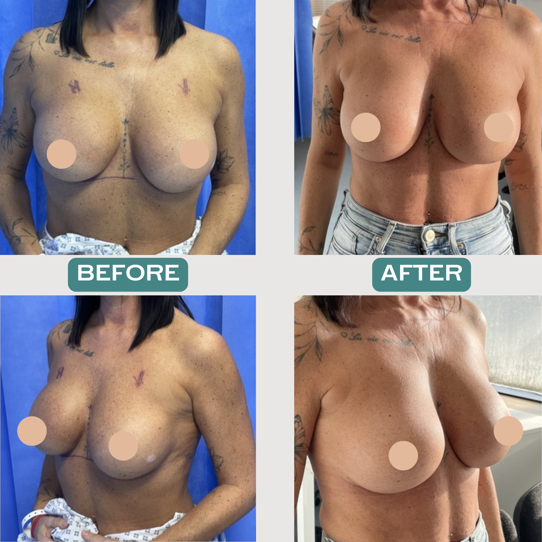 Implant Replacement & Repositioning