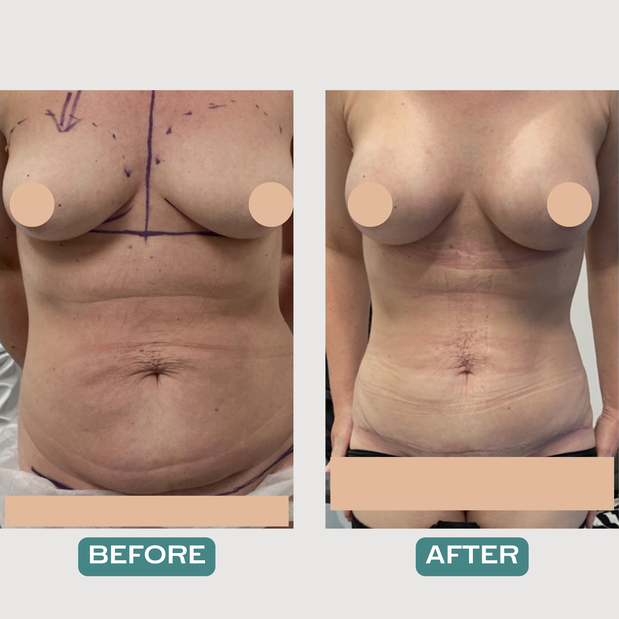 'Mummy Makeover'- Breast Augmentation & Mini Abdominoplasty with Liposuction