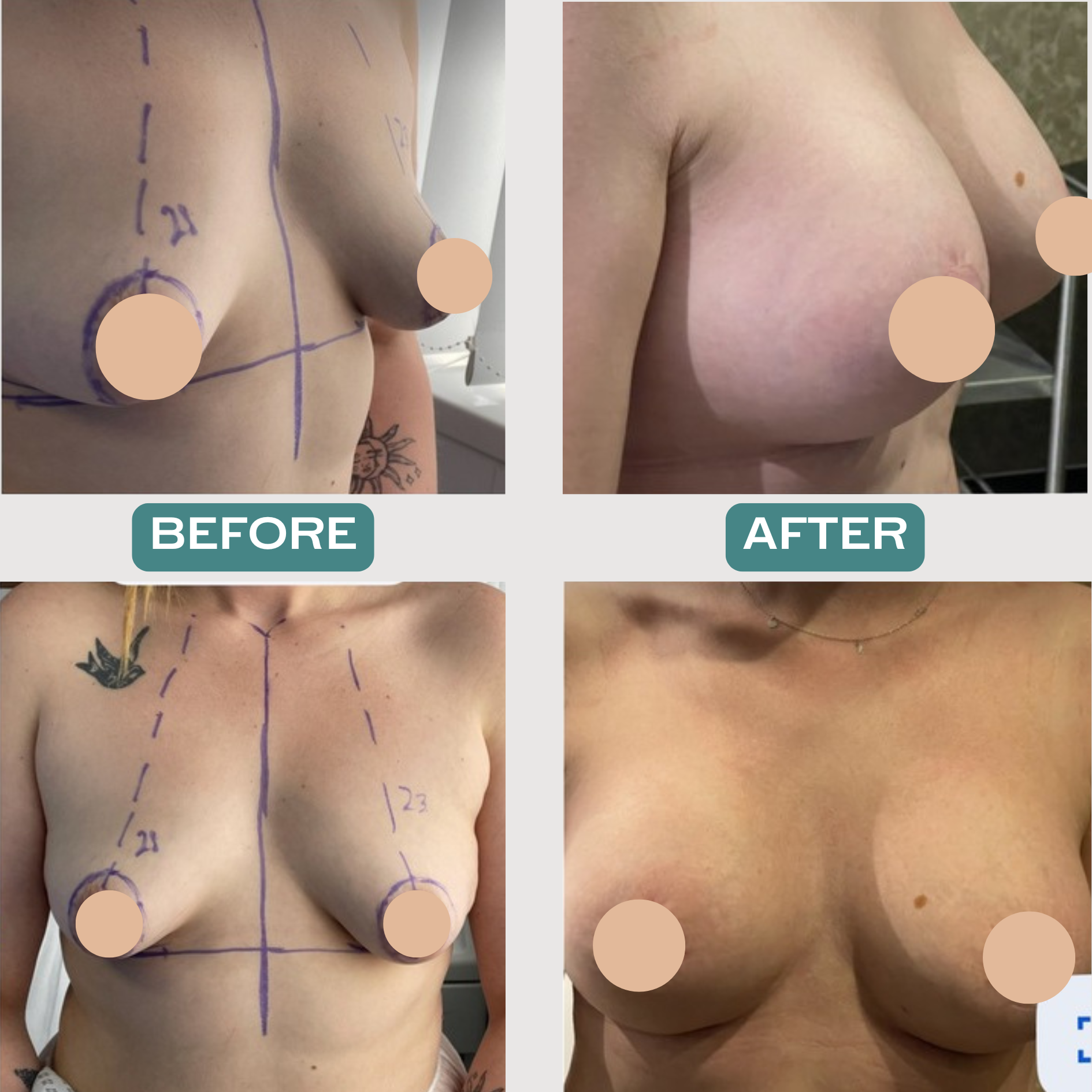 Tubular Breast Correction
