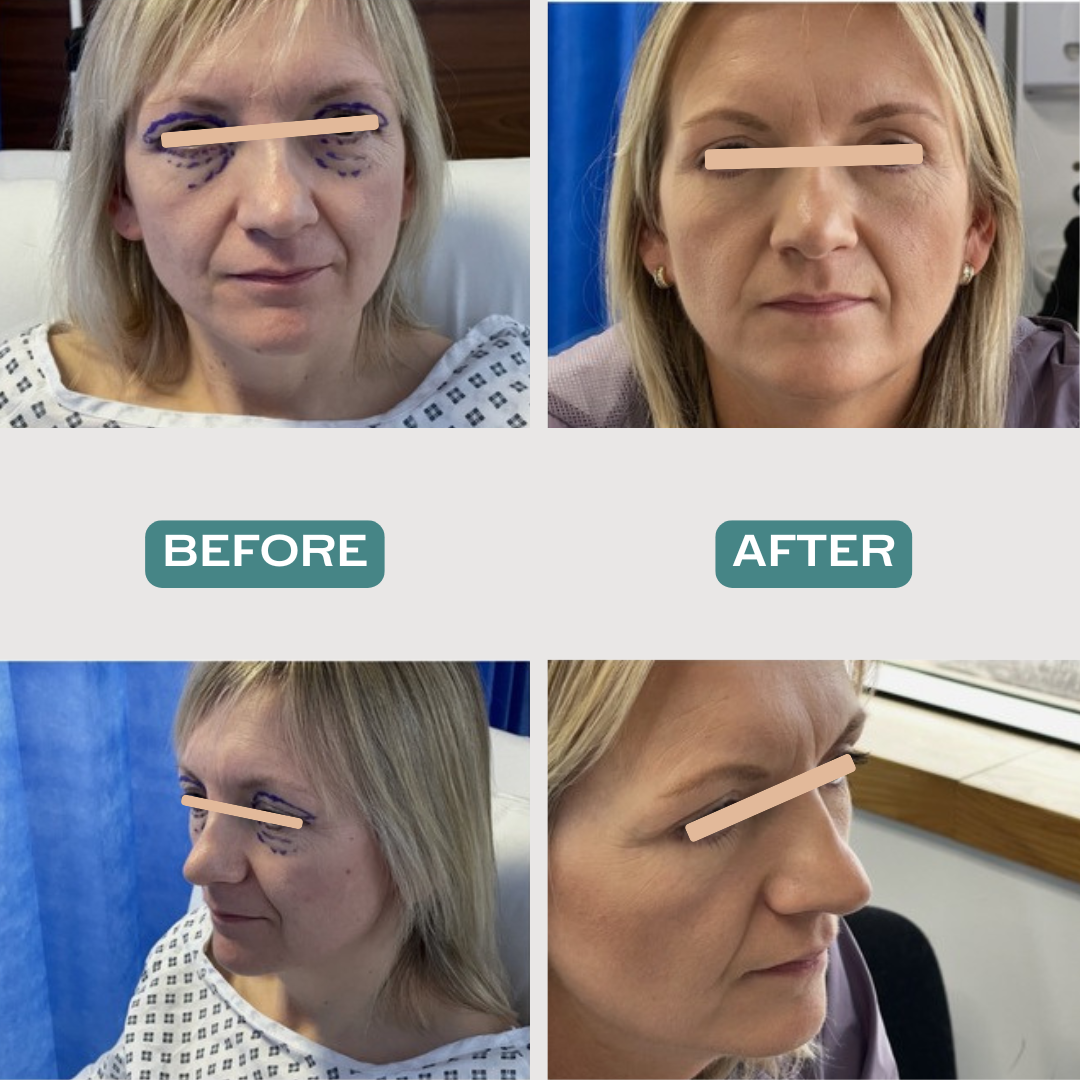 Upper Blepharoplasty