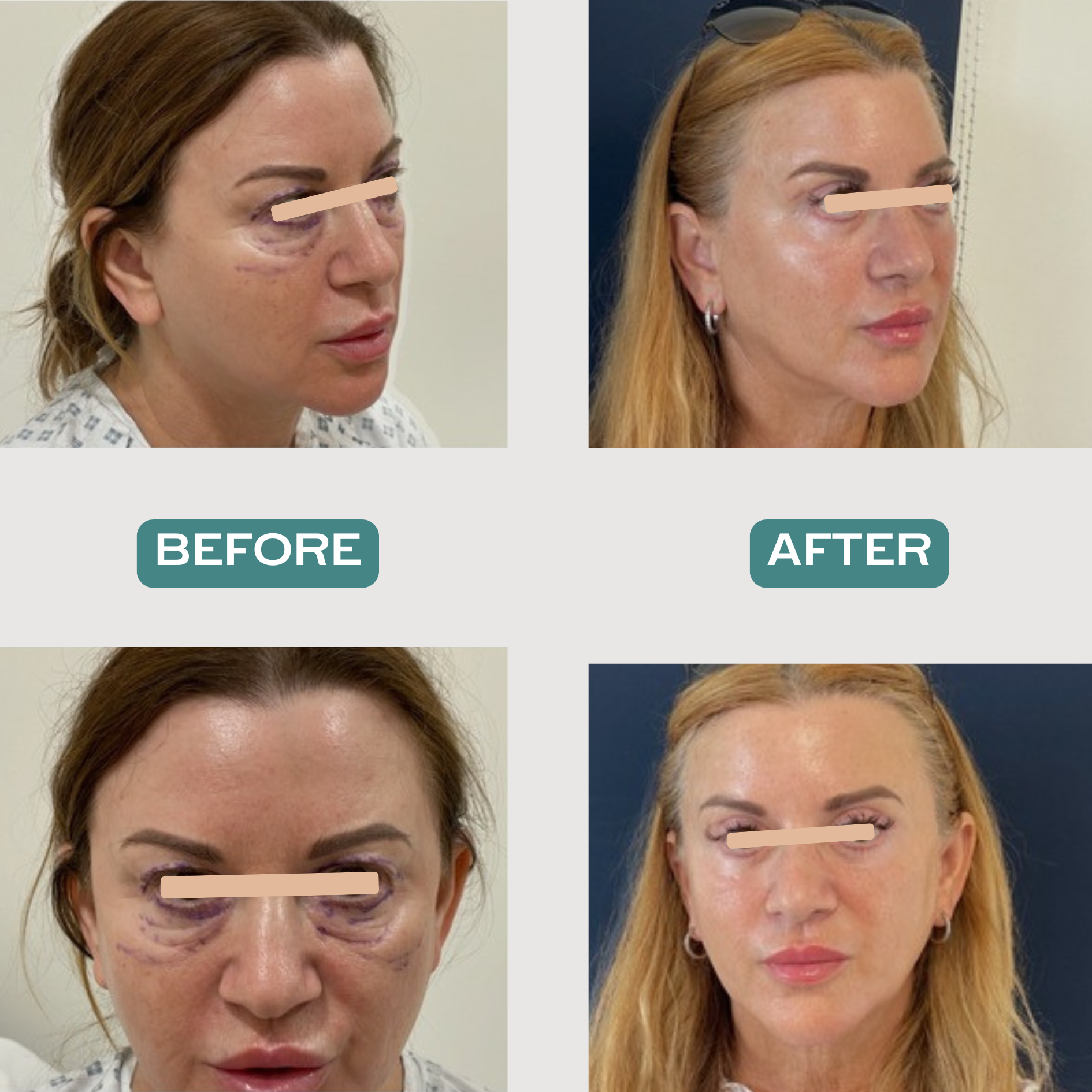 Upper and Lower Blepharoplasty