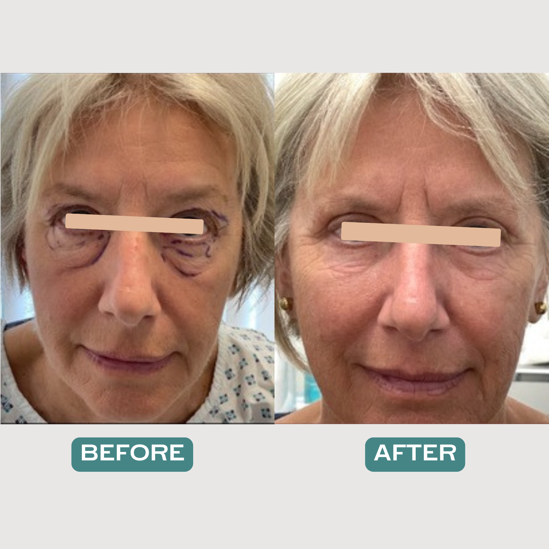Upper and Lower Blepharoplasty